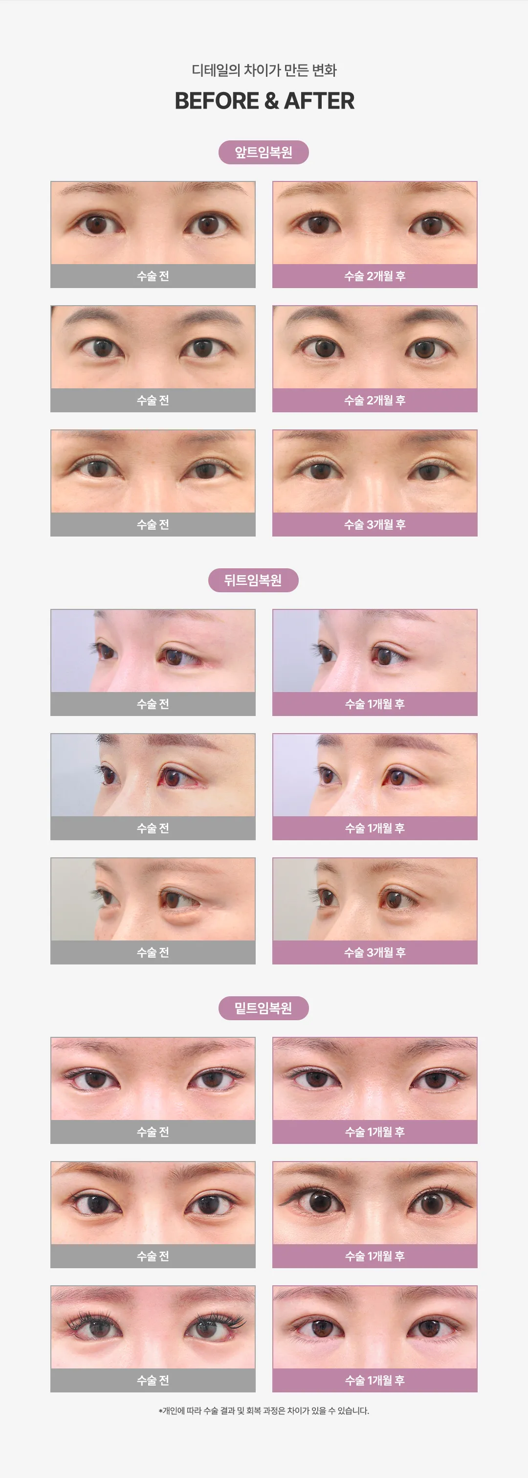 올로 트임복원 시술 안내